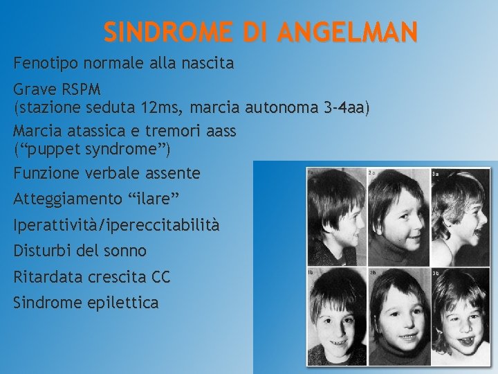 SINDROME DI ANGELMAN Fenotipo normale alla nascita Grave RSPM (stazione seduta 12 ms, marcia