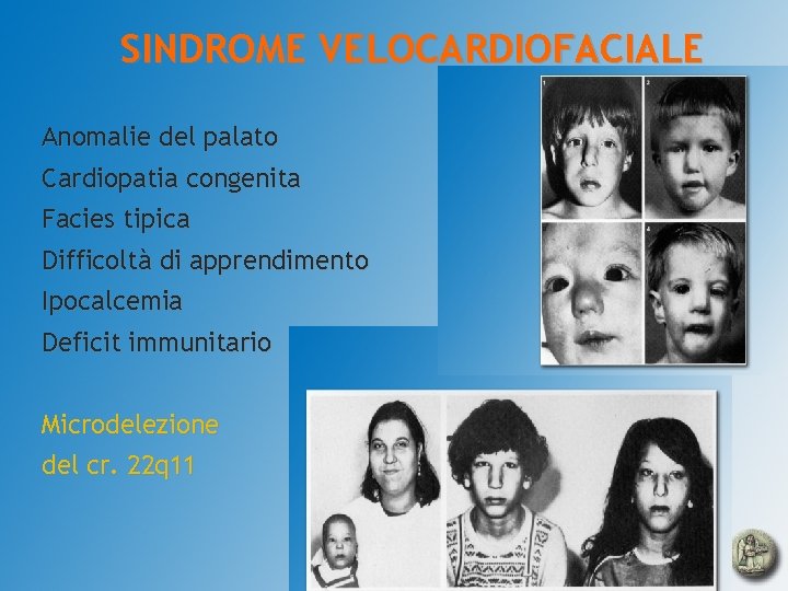 SINDROME VELOCARDIOFACIALE Anomalie del palato Cardiopatia congenita Facies tipica Difficoltà di apprendimento Ipocalcemia Deficit