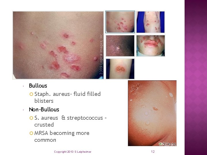  Bullous Staph. aureus- fluid filled blisters Non-Bullous S. aureus & streptococcus – crusted