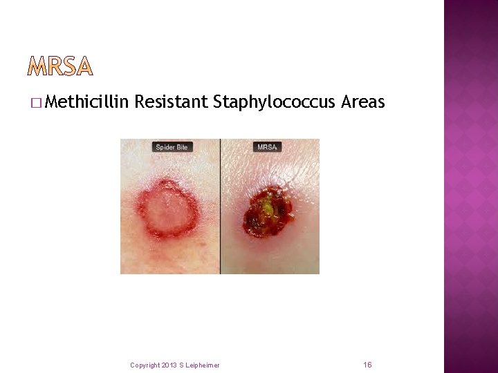 � Methicillin Resistant Staphylococcus Areas Copyright 2013 S Leipheimer 16 