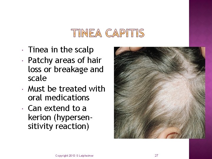  Tinea in the scalp Patchy areas of hair loss or breakage and scale