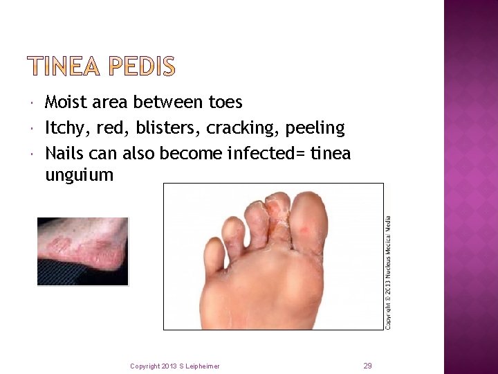  Moist area between toes Itchy, red, blisters, cracking, peeling Nails can also become