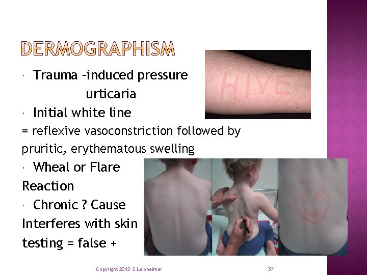  Trauma –induced pressure urticaria Initial white line = reflexive vasoconstriction followed by pruritic,