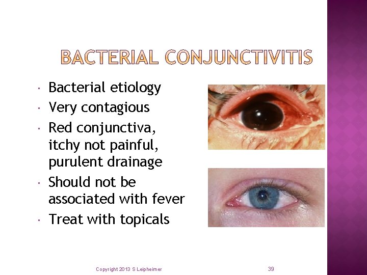  Bacterial etiology Very contagious Red conjunctiva, itchy not painful, purulent drainage Should not