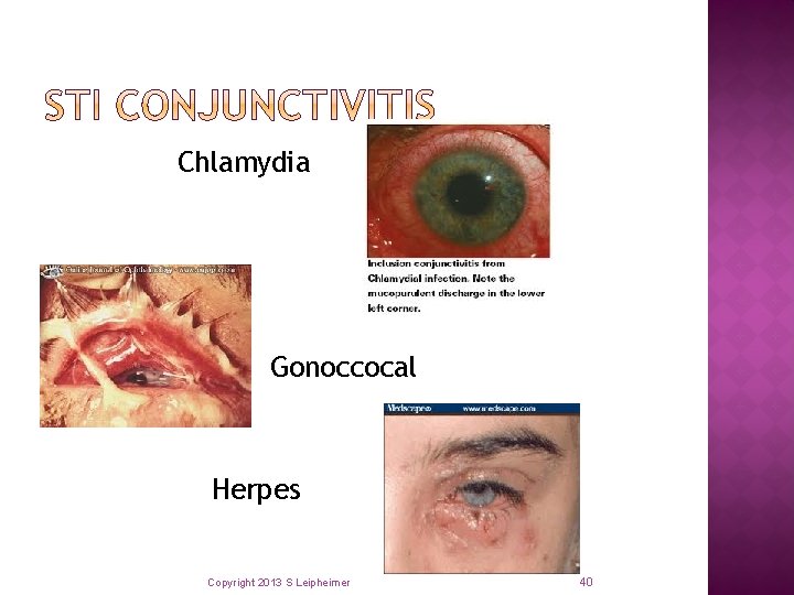 Chlamydia Gonoccocal Herpes Copyright 2013 S Leipheimer 40 