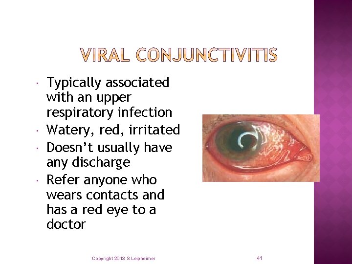  Typically associated with an upper respiratory infection Watery, red, irritated Doesn’t usually have