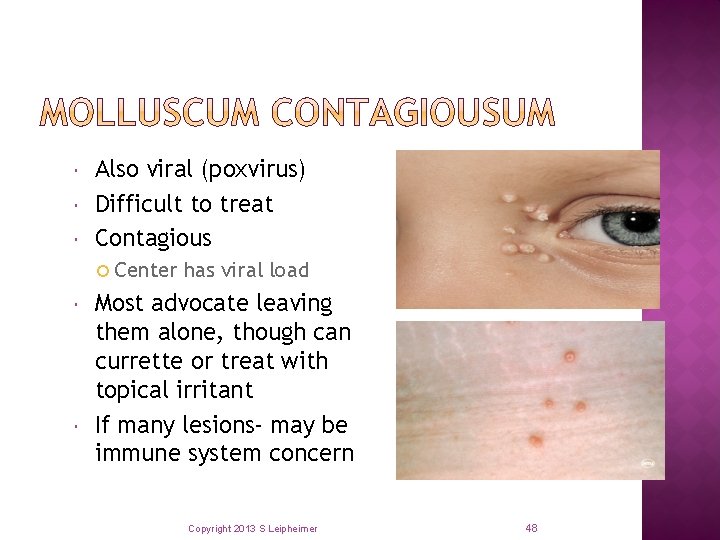 Also viral (poxvirus) Difficult to treat Contagious Center has viral load Most advocate