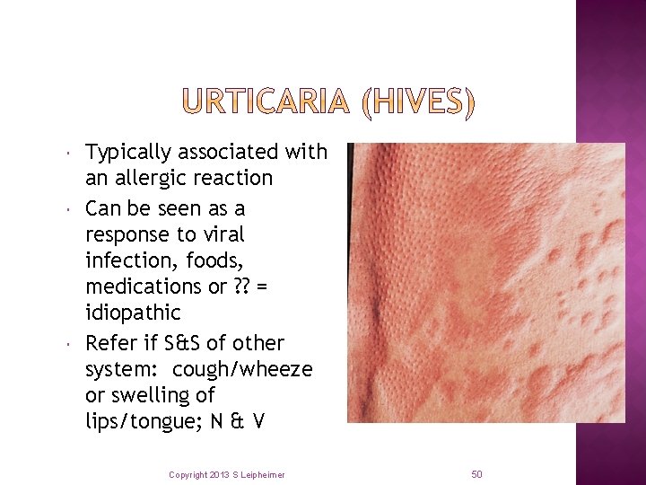  Typically associated with an allergic reaction Can be seen as a response to