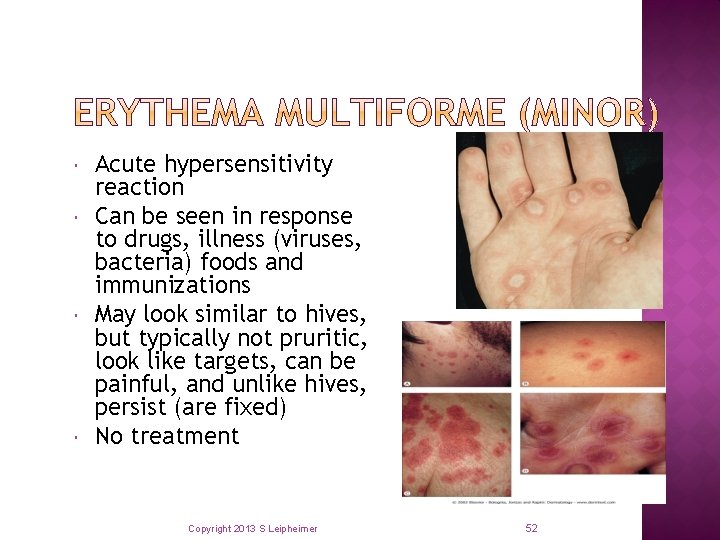  Acute hypersensitivity reaction Can be seen in response to drugs, illness (viruses, bacteria)