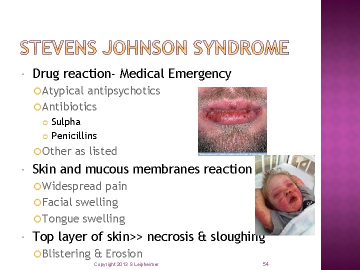  Drug reaction- Medical Emergency Atypical antipsychotics Antibiotics Sulpha Penicillins Other as listed Skin