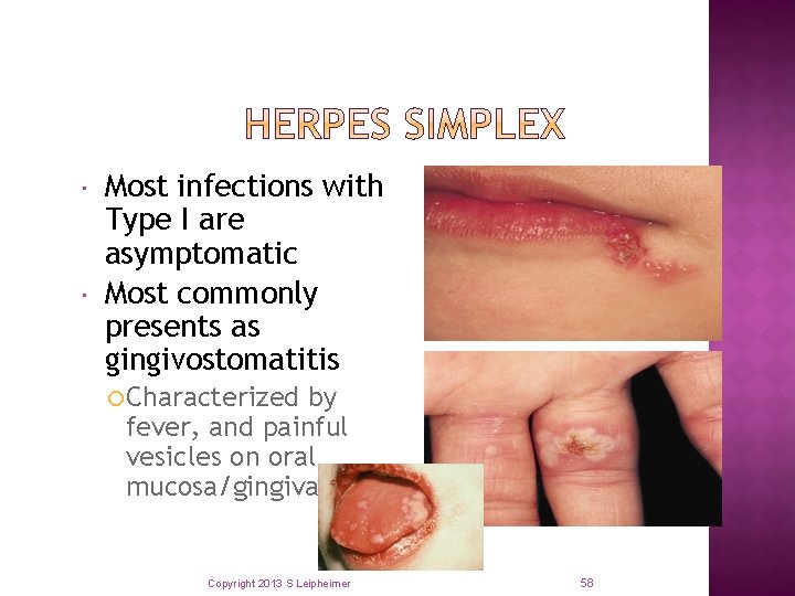  Most infections with Type I are asymptomatic Most commonly presents as gingivostomatitis Characterized