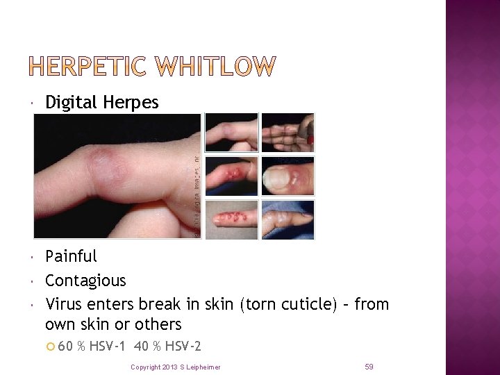  Digital Herpes Painful Contagious Virus enters break in skin (torn cuticle) – from