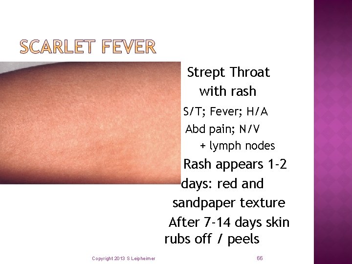  Strept Throat with rash S/T; Fever; H/A Abd pain; N/V + lymph nodes