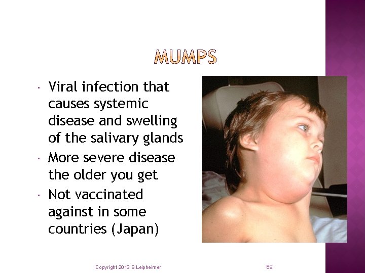  Viral infection that causes systemic disease and swelling of the salivary glands More