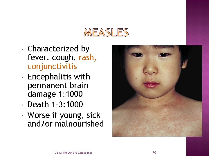  Characterized by fever, cough, rash, conjunctivitis Encephalitis with permanent brain damage 1: 1000