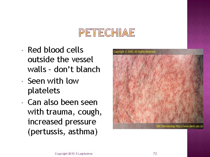  Red blood cells outside the vessel walls – don’t blanch Seen with low