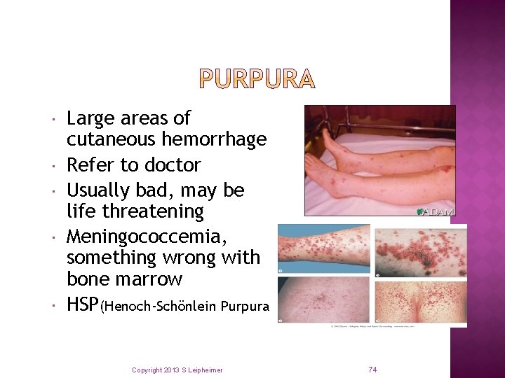  Large areas of cutaneous hemorrhage Refer to doctor Usually bad, may be life