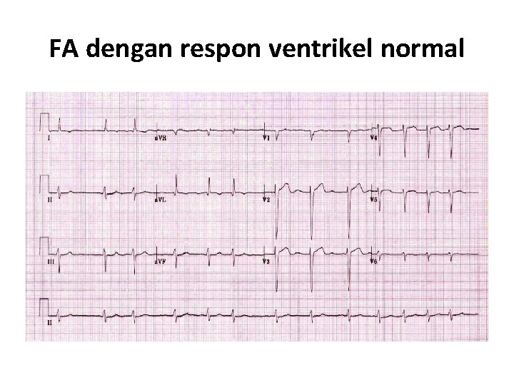FA dengan respon ventrikel normal 