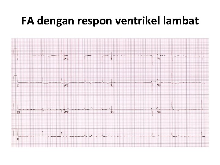 FA dengan respon ventrikel lambat 