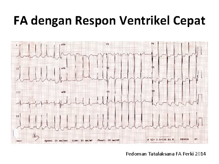 FA dengan Respon Ventrikel Cepat Pedoman Tatalaksana FA Perki 2014 