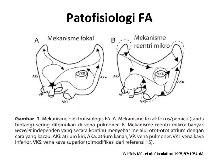 Patofisiologi FA Wijffels MC, et al. Circulation 1995; 92: 1954 -68 