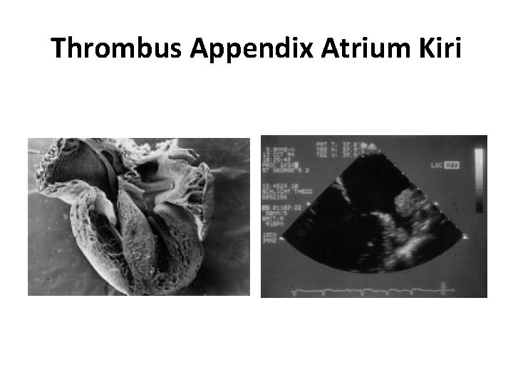 Thrombus Appendix Atrium Kiri 