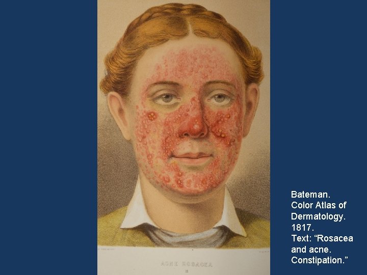 Bateman. Color Atlas of Dermatology. 1817. Text: “Rosacea and acne. Constipation. ” 