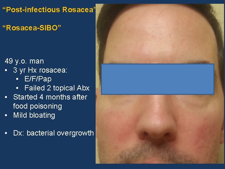 “Post-infectious Rosacea” “Rosacea-SIBO” 49 y. o. man • 3 yr Hx rosacea: • E/F/Pap