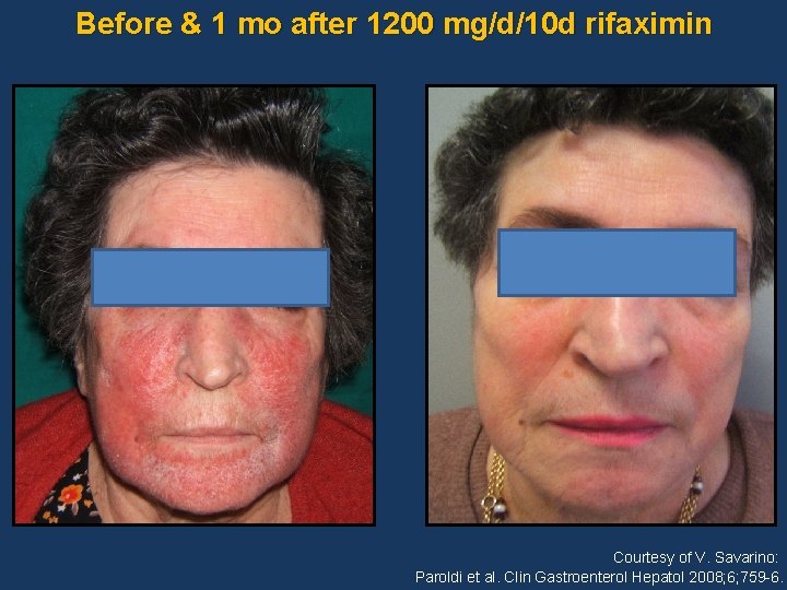 Before & 1 mo after 1200 mg/d/10 d rifaximin Courtesy of V. Savarino: Paroldi