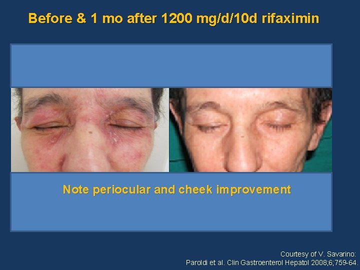 Before & 1 mo after 1200 mg/d/10 d rifaximin Note periocular and cheek improvement