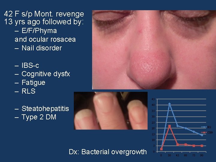 42 F s/p Mont. revenge 13 yrs ago followed by: – E/F/Phyma and ocular