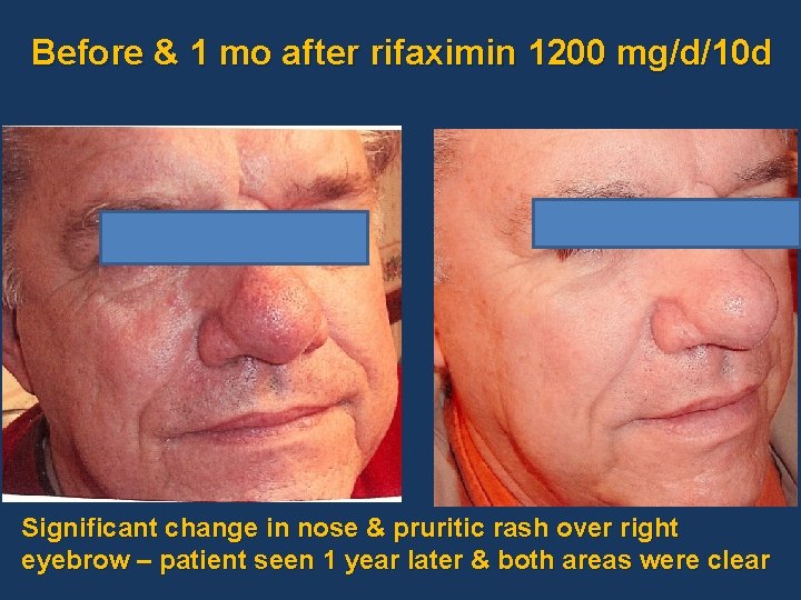 Before & 1 mo after rifaximin 1200 mg/d/10 d Significant change in nose &