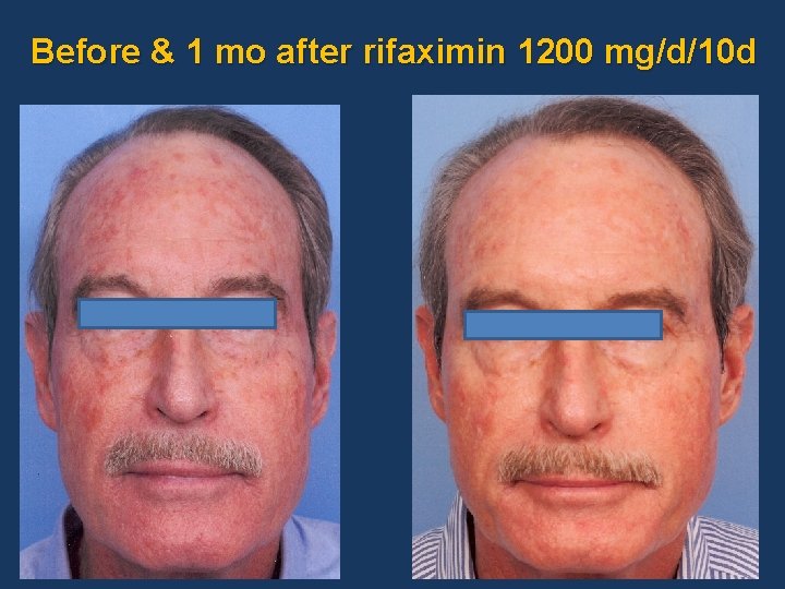 Before & 1 mo after rifaximin 1200 mg/d/10 d 
