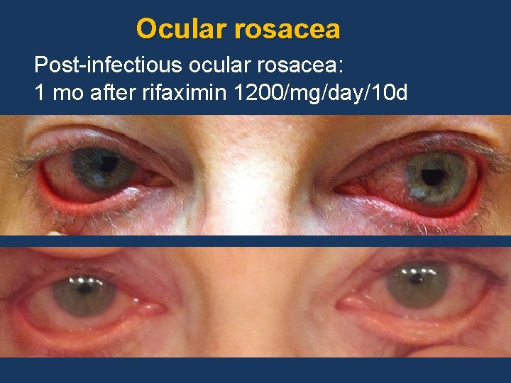 Ocular rosacea Post-infectious ocular rosacea: 1 mo after rifaximin 1200/mg/day/10 d 