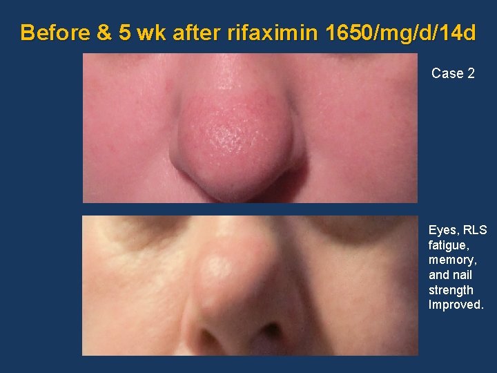 Before & 5 wk after rifaximin 1650/mg/d/14 d Case 2 Eyes, RLS fatigue, memory,