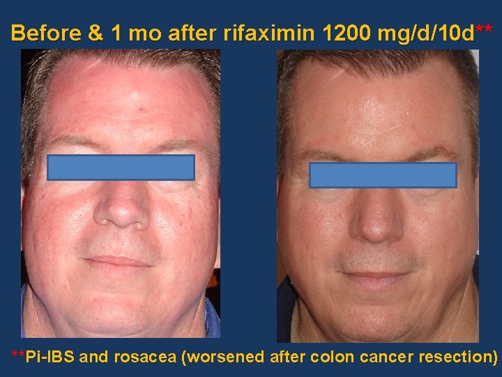 Before & 1 mo after rifaximin 1200 mg/d/10 d** **Pi-IBS and rosacea (worsened after