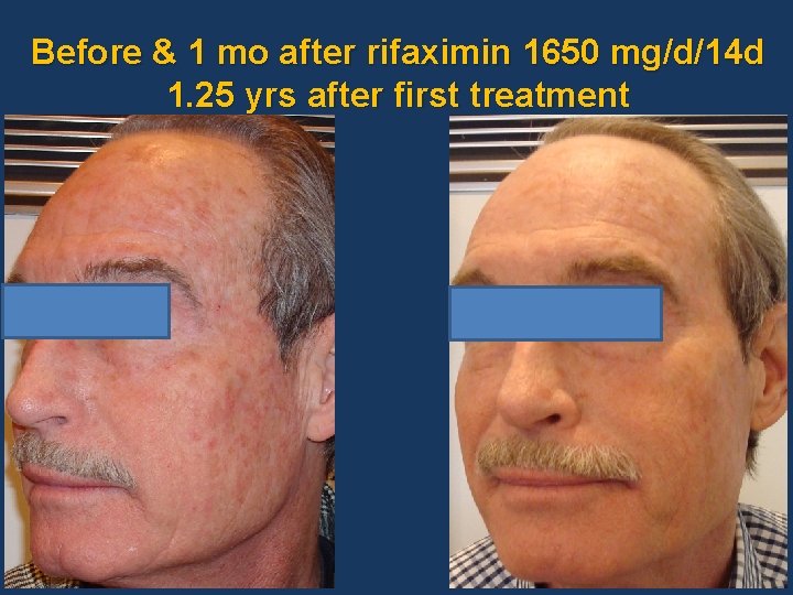 Before & 1 mo after rifaximin 1650 mg/d/14 d 1. 25 yrs after first