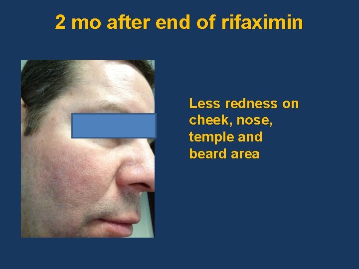 2 mo after end of rifaximin Less redness on cheek, nose, temple and beard