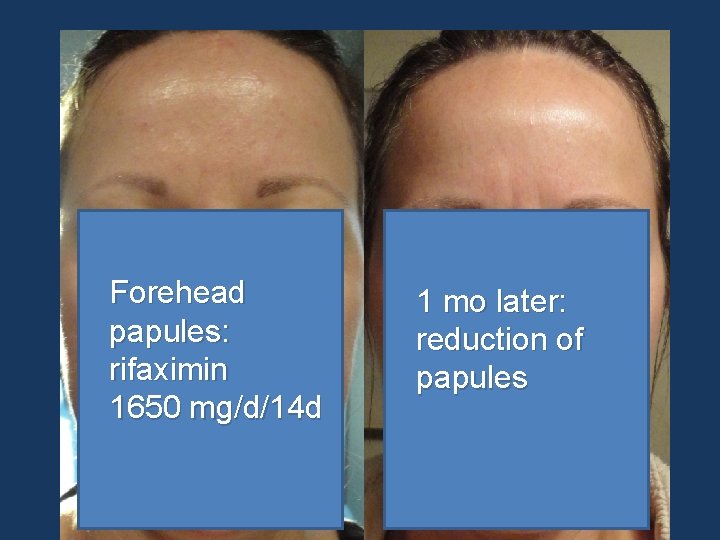 Forehead papules: rifaximin 1650 mg/d/14 d 1 mo later: reduction of papules 