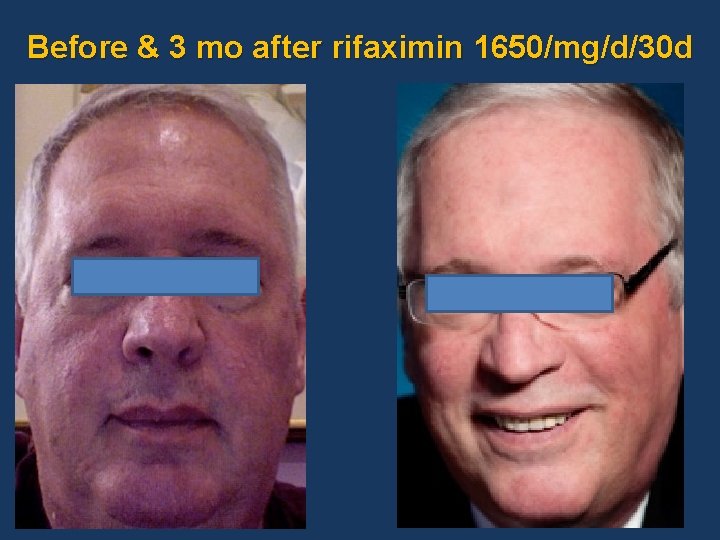 Before & 3 mo after rifaximin 1650/mg/d/30 d 