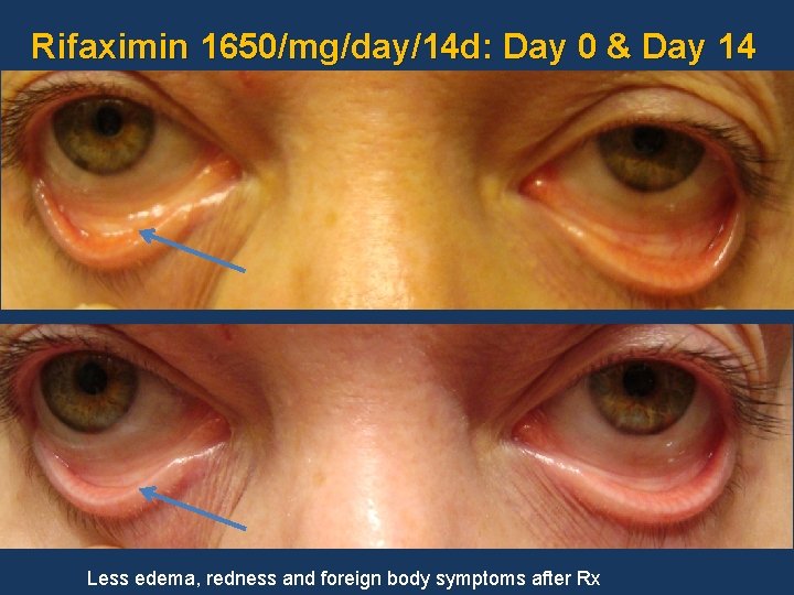 Rifaximin 1650/mg/day/14 d: Day 0 & Day 14 Less edema, redness and foreign body