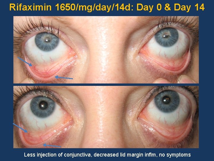 Rifaximin 1650/mg/day/14 d: Day 0 & Day 14 Less injection of conjunctiva, decreased lid