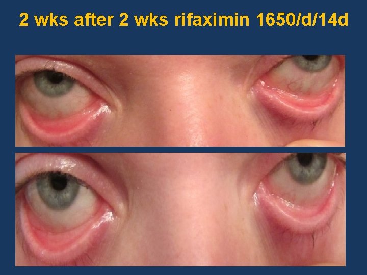 2 wks after 2 wks rifaximin 1650/d/14 d 