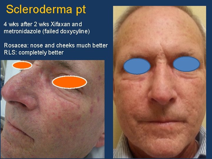  Scleroderma pt 4 wks after 2 wks Xifaxan and metronidazole (failed doxycyline) Rosacea: