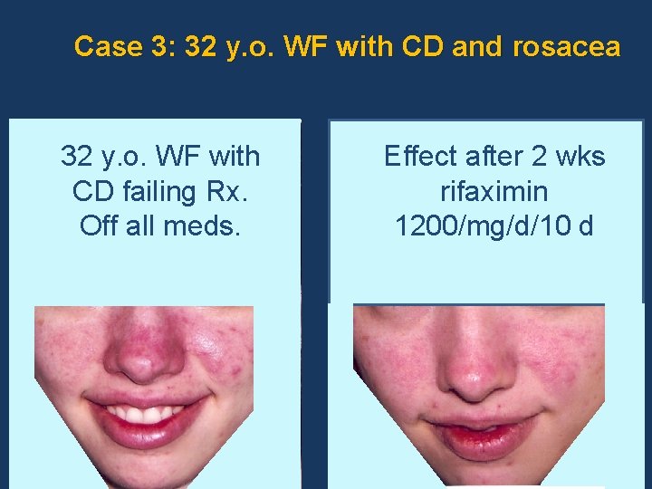 Case 3: 32 y. o. WF with CD and rosacea 32 y. o. WF