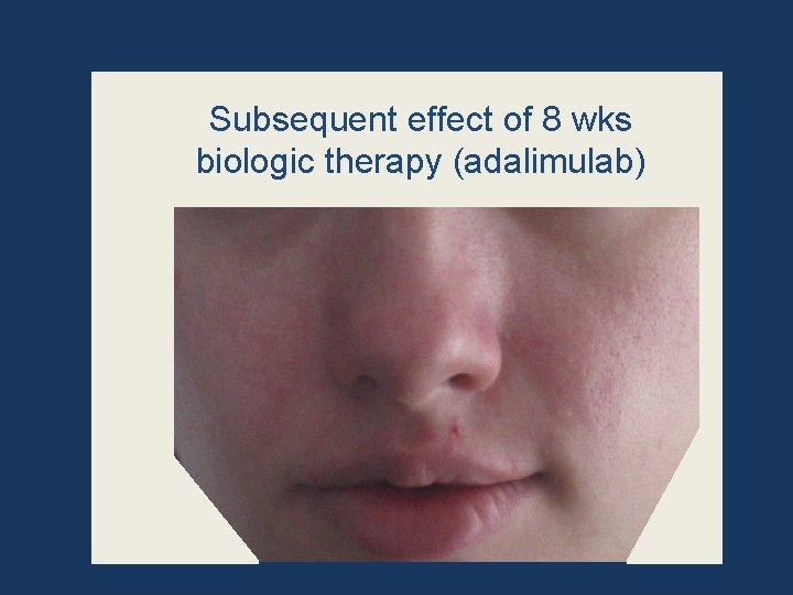 Subsequent effect of 8 wks biologic therapy (adalimulab) 