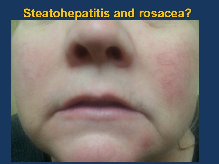 Steatohepatitis and rosacea? 