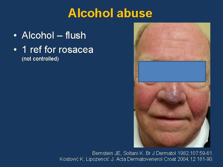 Alcohol abuse • Alcohol – flush • 1 ref for rosacea (not controlled) Bernstein