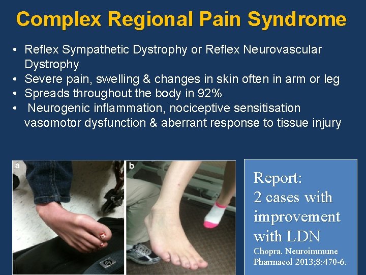Complex Regional Pain Syndrome • Reflex Sympathetic Dystrophy or Reflex Neurovascular Dystrophy • Severe