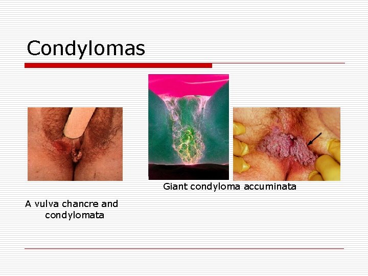 Condylomas Giant condyloma accuminata A vulva chancre and condylomata 